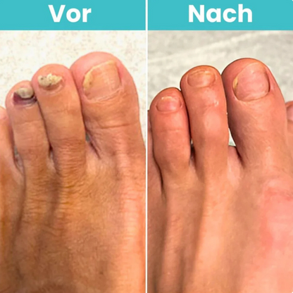 NagelKlar Pro | Klare, Gesund Aussehende Nägel Zu Hause Wiederherstellen