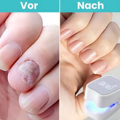 NagelKlar Pro | Klare, Gesund Aussehende Nägel Zu Hause Wiederherstellen
