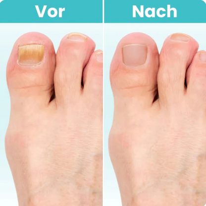 NagelKlar Pro | Klare, Gesund Aussehende Nägel Zu Hause Wiederherstellen